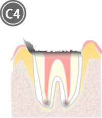 C4：歯質が失われた虫歯